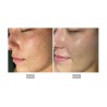 Hydrofacial profesional