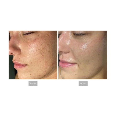Hydrofacial profesional