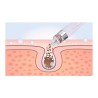 Hydrofacial profesional